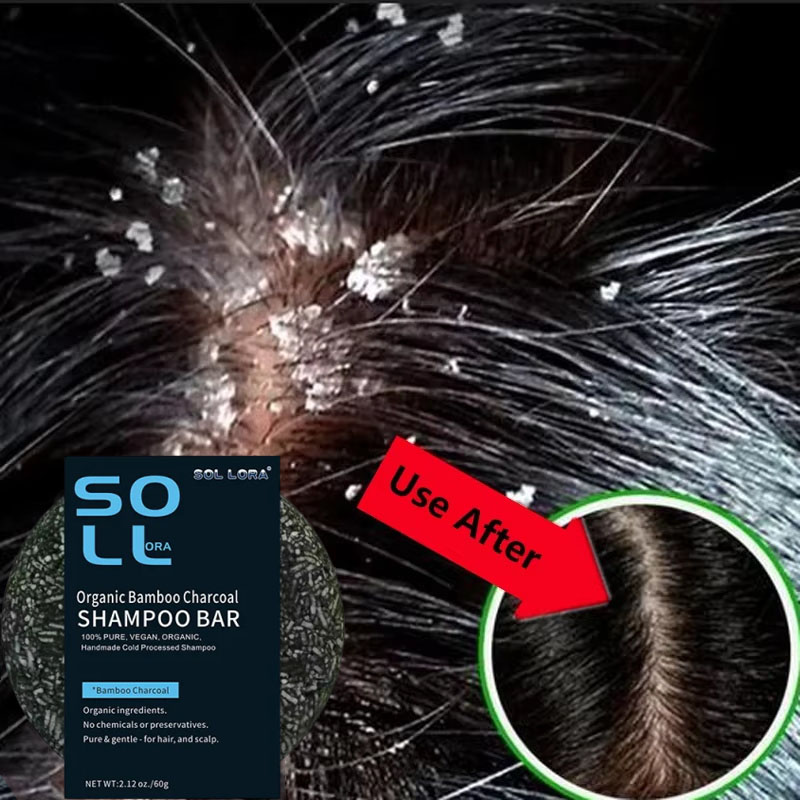 빠른 비듬 방지 헤어 트리트먼트 비누 가려움증 수리 두 - Hair Care Dandruff 리뷰 및 가격