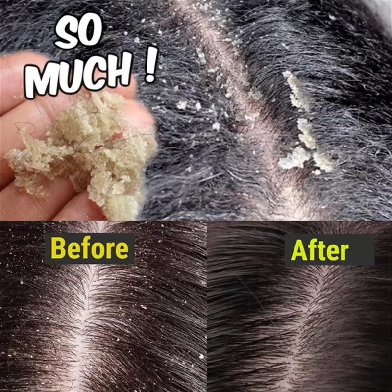 빠른 비듬 방지 헤어 트리트먼트 비누 가려움증 수리 두 - Hair Care Dandruff 리뷰 및 가격